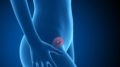 abortion pill